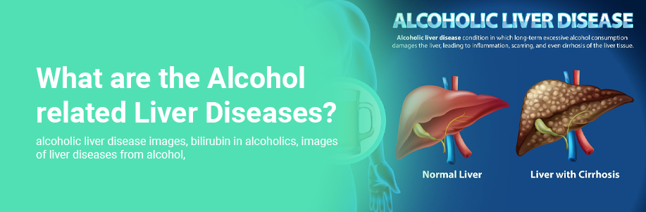 What are the Alcohol related Liver Diseases?